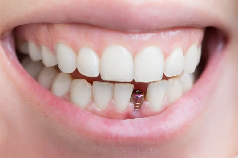 Leia mais sobre o artigo Implantes Dentarios