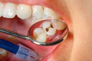 Leia mais sobre o artigo Tudo Sobre Endodontia