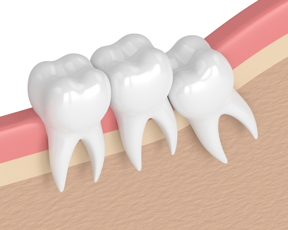 Leia mais sobre o artigo Tudo Sobre O Dente Siso